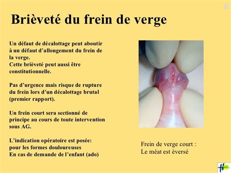 déchirure frein|La rupture du frein du prépuce